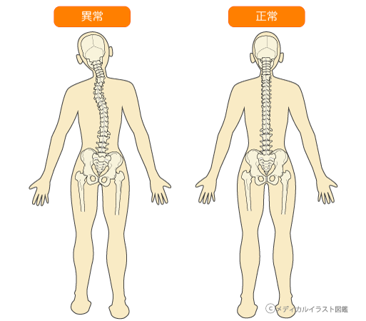 背骨の歪み
