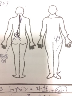 左腰部側弯あり　左股関節外転外旋あり