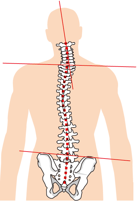 頚椎の変位